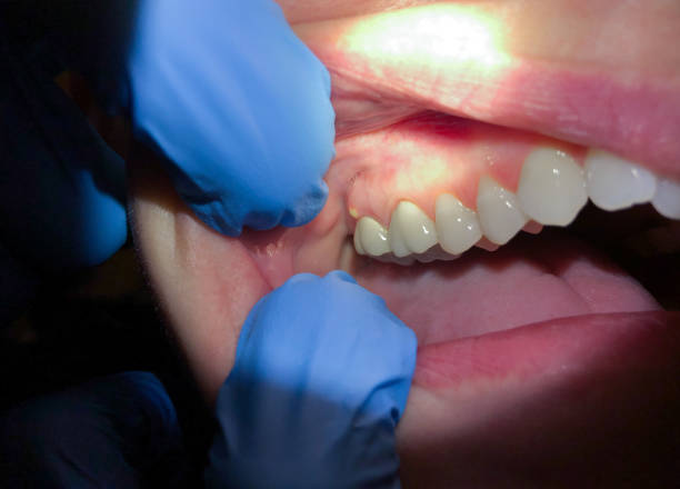 Best Knocked-Out Tooth Emergency  in Grinnell, IA